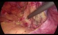 Sigmoidectomía Laparoscópica - Movilización de Flexión Esplénica Lateral a Medial 