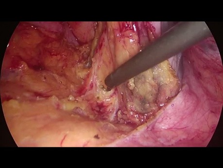 Sigmoidectomía Laparoscópica - Movilización de Flexión Esplénica Lateral a Medial 