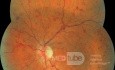 Trombosis de la vena central de la retina