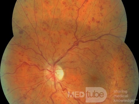 Trombosis de la vena central de la retina