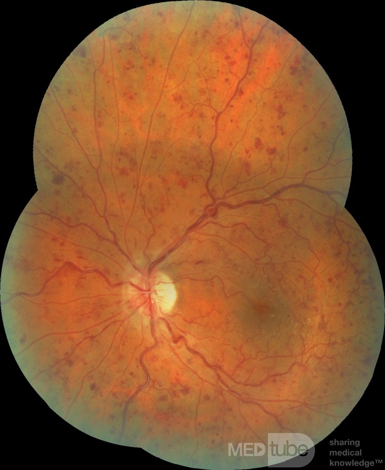 Trombosis de la vena central de la retina