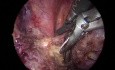 Extirpación quirúrgica toracoscópica asistida por video derecha de schwannoma con uso de TriPort 