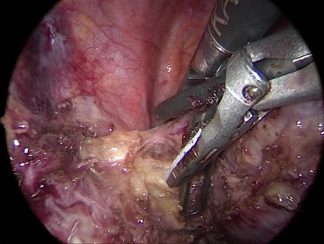 Extirpación quirúrgica toracoscópica asistida por video derecha de schwannoma con uso de TriPort 