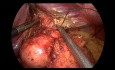 Rehacer la fundoplicatura de Nissen después de la recurrencia de ERGE