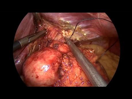 Rehacer la fundoplicatura de Nissen después de la recurrencia de ERGE