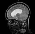 Tercera ventriculostomía endoscópica en un caso benigno de síndrome de Aicardi con hidrocefalia obstructiva y malformación de Chiari tipo 1