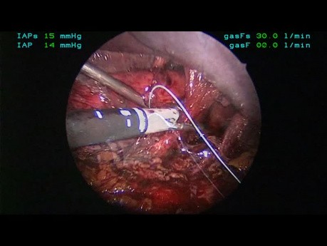 Reparación laparoscópica de hernia parahiatal con malla 