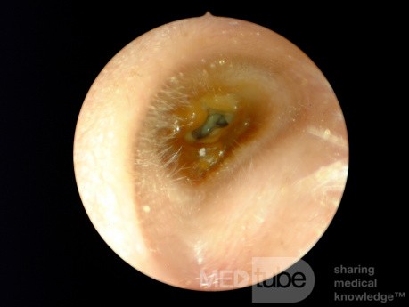Otitis externa crónica de patógenos mixtos