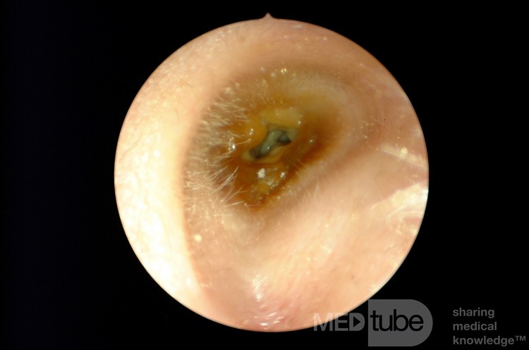 Otitis externa crónica de patógenos mixtos