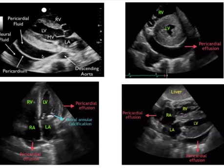 Evaluación ecocardiográfica de los derrames pericárdicos: ¿golpear o no golpear?