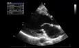 Un test de ecocardiografía: ¿Cuál es la gravedad de la regurgitación aórtica?