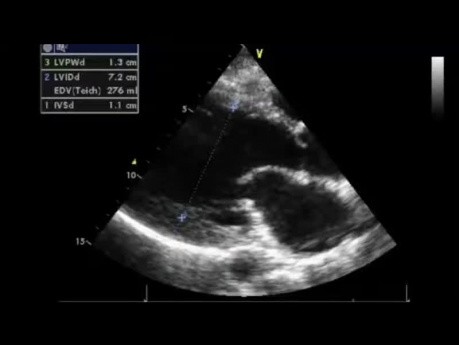 Un test de ecocardiografía: ¿Cuál es la gravedad de la regurgitación aórtica?