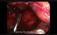 Extirpación laparoscópica de un seudoquiste pancreático postinfeccioso