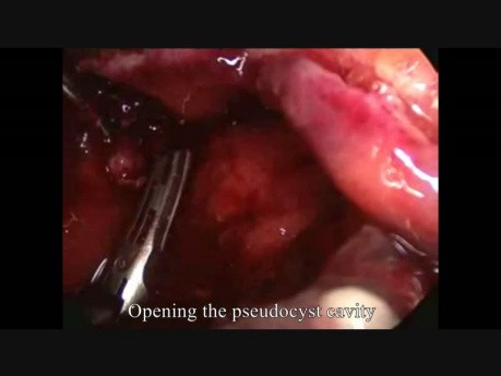 Extirpación laparoscópica de un seudoquiste pancreático postinfeccioso