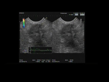 Masa pancreática con invasión de la vena porta