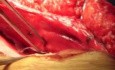 Resección intestinal en hernia incisional