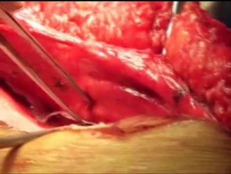 Resección intestinal en hernia incisional