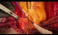 Paciente con endocarditis de doble válvula y fístula entre dos troncos