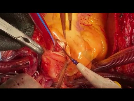 Paciente con endocarditis de doble válvula y fístula entre dos troncos