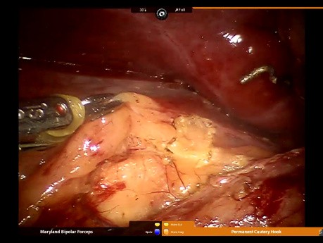 Adrenalectomía derecha asistida por robot con trombectomía de la vena cava inferior.