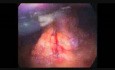Esplenectomía laparoscópica     