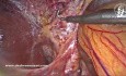 Colecistectomía laparoscópica segura