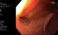 CPRE en anatomía alterada