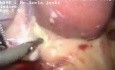 Gastrectomía en manga con colecistectomía y hernioplastia con malla