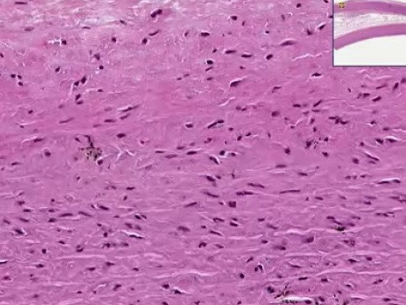 Ateroesclerosis con manchas lipídicas - histopatología - aorta