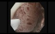 Resección endoscópica de mucosa (REM) subacuática