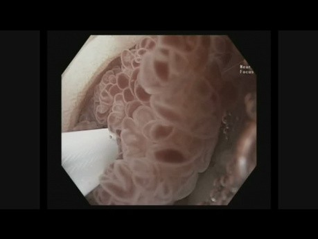 Resección endoscópica de mucosa (REM) subacuática