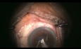 Cirugía de cataratas compleja con sorpresa de zonula faltante