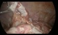 Obstrucción intestinal por apendicitis aguda