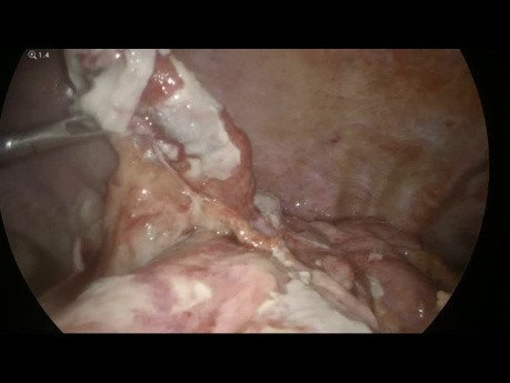 Obstrucción intestinal por apendicitis aguda