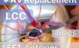 TCRAT-CABG + AVR mediante toracotomía anterior izquierda
