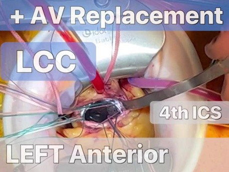 TCRAT-CABG + AVR mediante toracotomía anterior izquierda