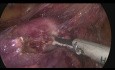 Histerectomía laparoscópica total + linfadenectomía realizada completamente