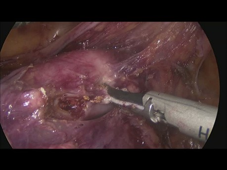 Histerectomía laparoscópica total + linfadenectomía realizada completamente