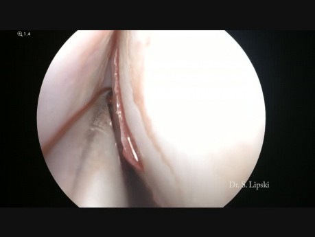 Pansinusitis + septo-turbinoplastia