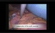 Procedimiento de bypass gástrico en un paciente con situs inverso total