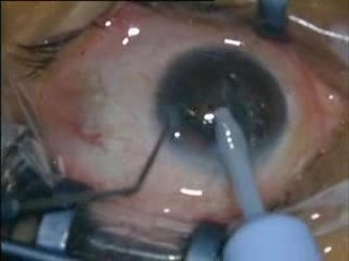 Cirugía de Catarata - Facoemulsificación
