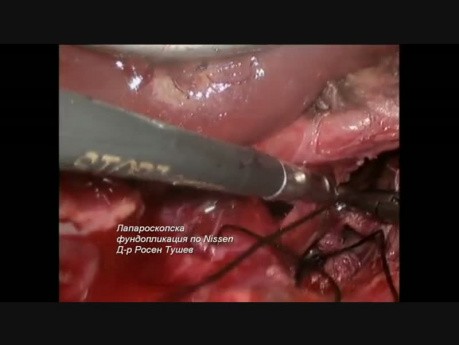 Funduplicatura laparoscópica de Nissen (ERGE)