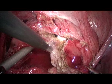 Resección laparoscópica de endometriosis vesical