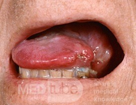 Carcinoma de células escamosas de la lengua