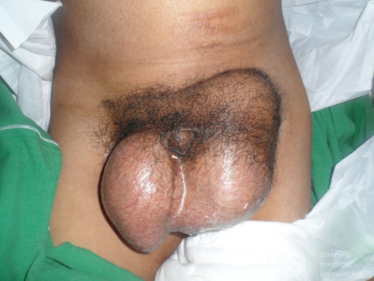 Hernia inguinal bilateral