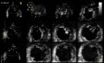 No compactación del ventrículo izquierdo en ecocardiografía 3D, Video nr 1