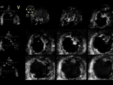 No compactación del ventrículo izquierdo en ecocardiografía 3D, Video nr 1