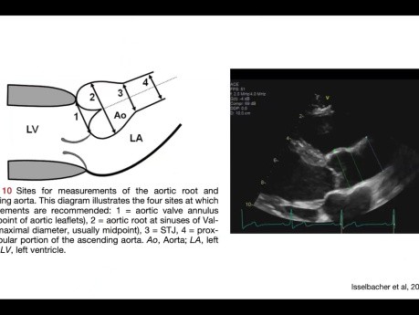 La quinta cámara del corazón: imágenes de ecocardiografía de la aorta torácica