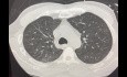 Resultados del uso de perfusión pulmonar ex vivo (EVLP) en pacientes con TV BE, DBD y ESRD