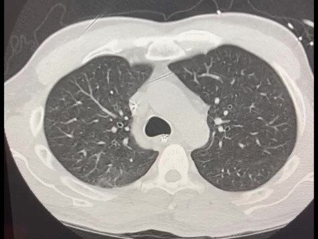 Resultados del uso de perfusión pulmonar ex vivo (EVLP) en pacientes con TV BE, DBD y ESRD